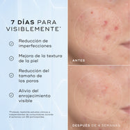 Primer plano «Antes» de la mejilla de un participante con imperfecciones visibles, enrojecimiento y poros dilatados rodeados por una línea blanca punteada. Primer plano «Después» de la mejilla del mismo participante, mostrando una reducción visible del enrojecimiento y una piel más uniforme dentro del círculo blanco punteado. Imagen dividida que muestra un primer plano de la textura de la piel etiquetada como «Antes» y «Después de 4 semanas», destacando las mejoras. El texto a la izquierda enumera los benef