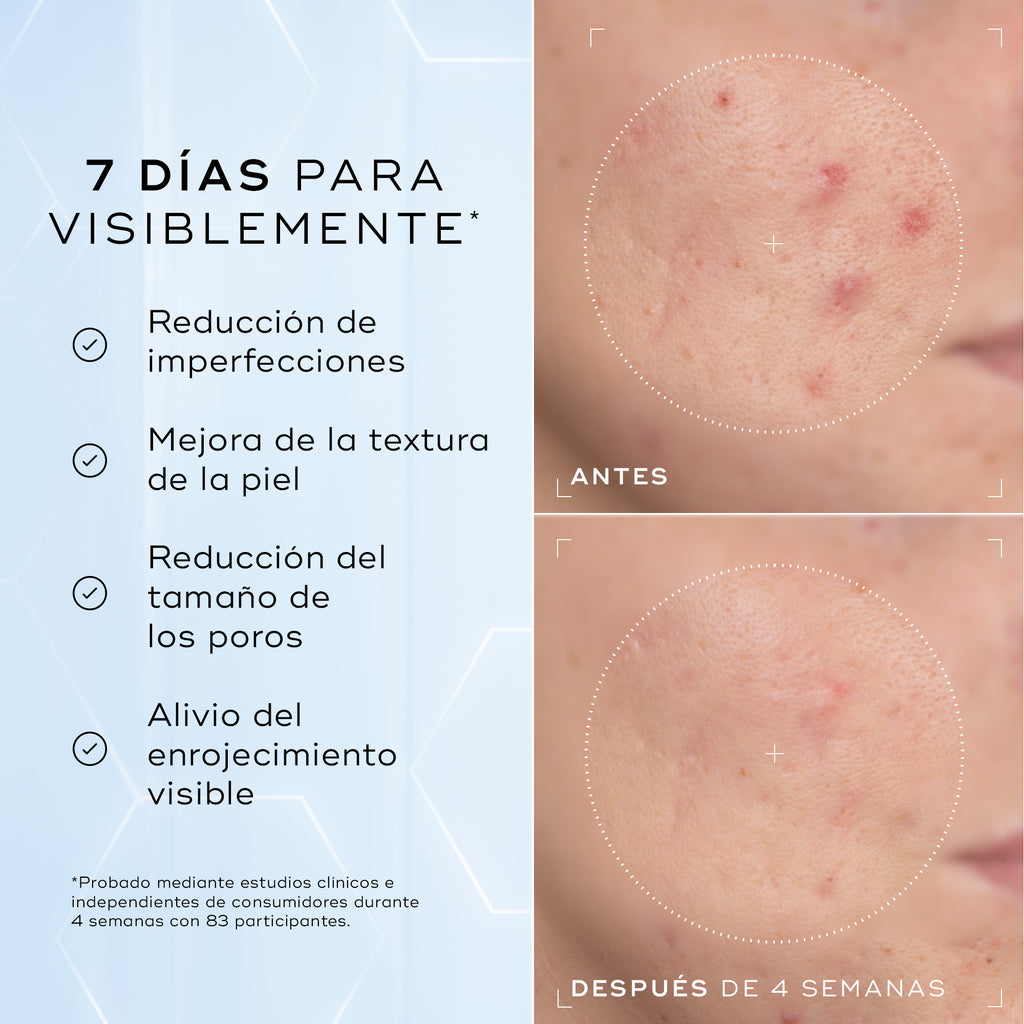Primer plano «Antes» de la mejilla de un participante con imperfecciones visibles, enrojecimiento y poros dilatados rodeados por una línea blanca punteada. Primer plano «Después» de la mejilla del mismo participante, mostrando una reducción visible del enrojecimiento y una piel más uniforme dentro del círculo blanco punteado. Imagen dividida que muestra un primer plano de la textura de la piel etiquetada como «Antes» y «Después de 4 semanas», destacando las mejoras. El texto a la izquierda enumera los benef